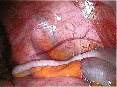 Vermiform appendix.